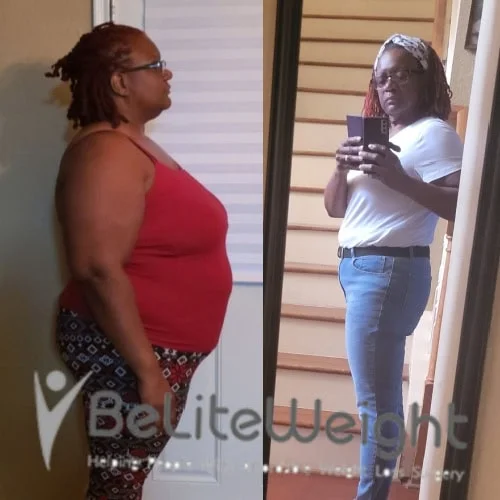 Weight Loss Surgery Before And After